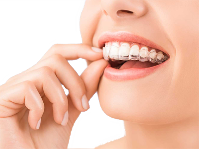 Centro Dentistico New Dental - Particolare Invisalign