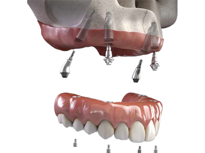 Centro Dentistico New Dental - Particolare Neodent Straumann
