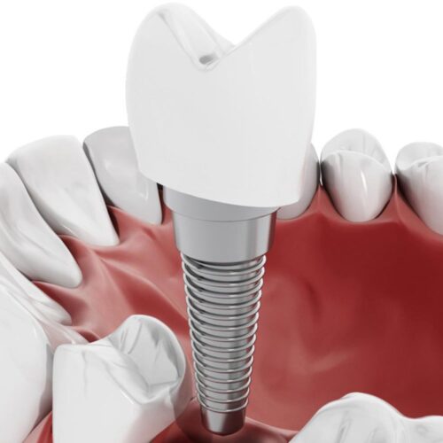 Centro Dentistico New Dental - Particolare Implantologia