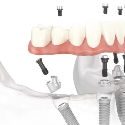 Centro Dentistico New Dental - Particolare Implantologia a carico immediato