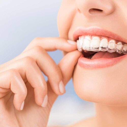 Centro Dentistico New Dental - Particolare Invisalign